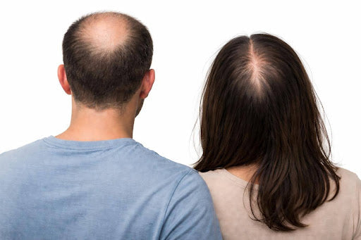 6 signes de début de calvitie qu'il ne faut jamais ignorer