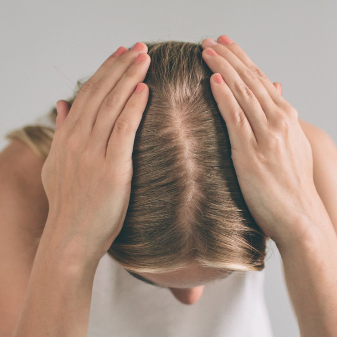 Perte de cheveux chez la femme