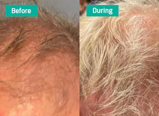 Neoffolics lotion stimulante pour la croissance des cheveux