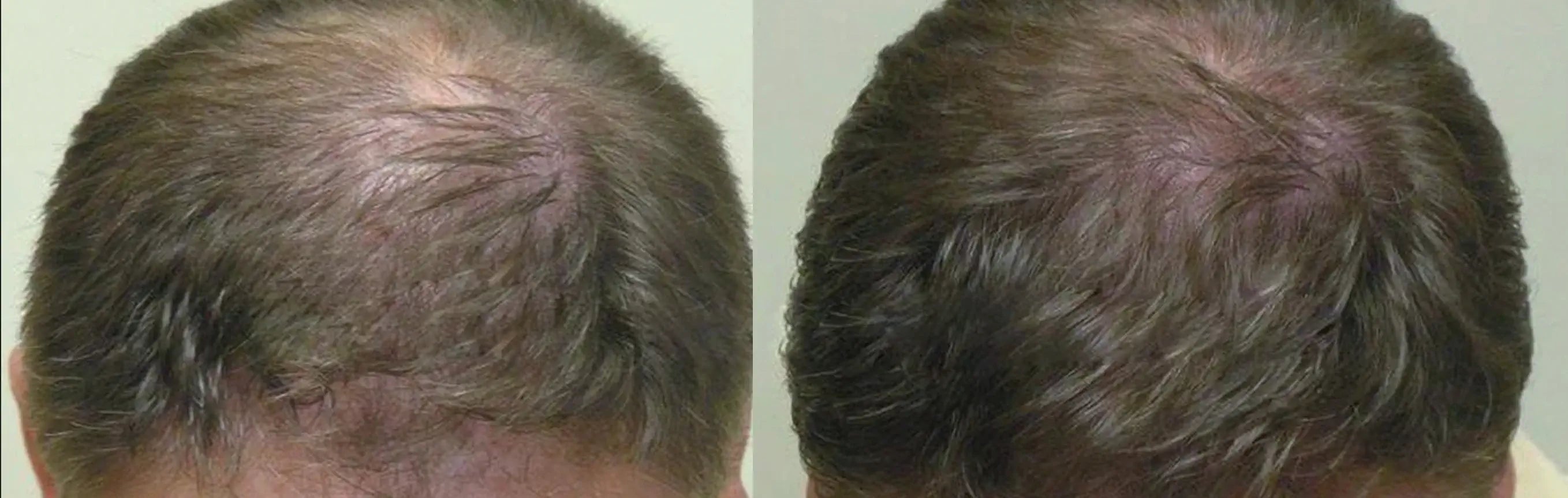 Neoffolics revitalisant stimulant la croissance des cheveux - 250ml