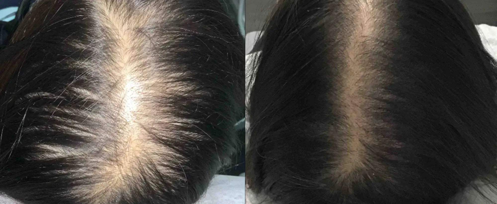 Neoffolics suppléments pour la perte de cheveux - 100 capsules