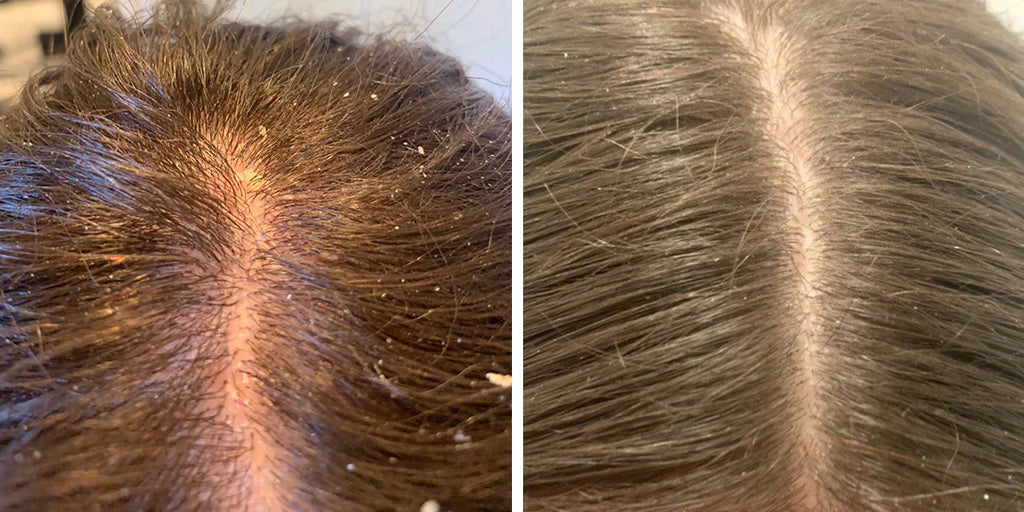 Neoffolics shampoing exfoliant - 250ml