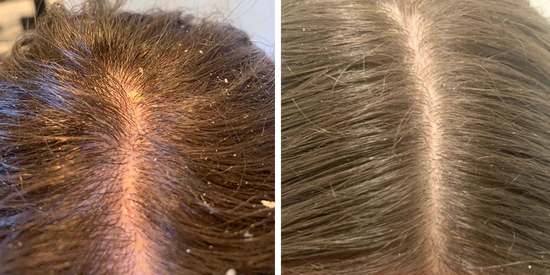 Neoffolics shampoing exfoliant - 250ml