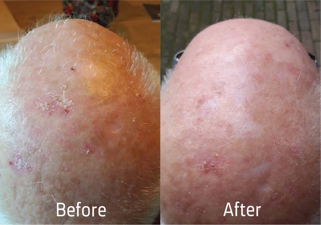 Neoffolics sérum desquamant pour le cuir chevelu - 90ml