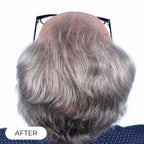 Capillus ONE casque de luminothérapie à faible niveau de laser (LLLT)