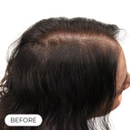 Capillus ONE casque de luminothérapie à faible niveau de laser (LLLT)