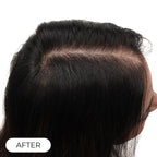 Capillus ONE casque de luminothérapie à faible niveau de laser (LLLT)