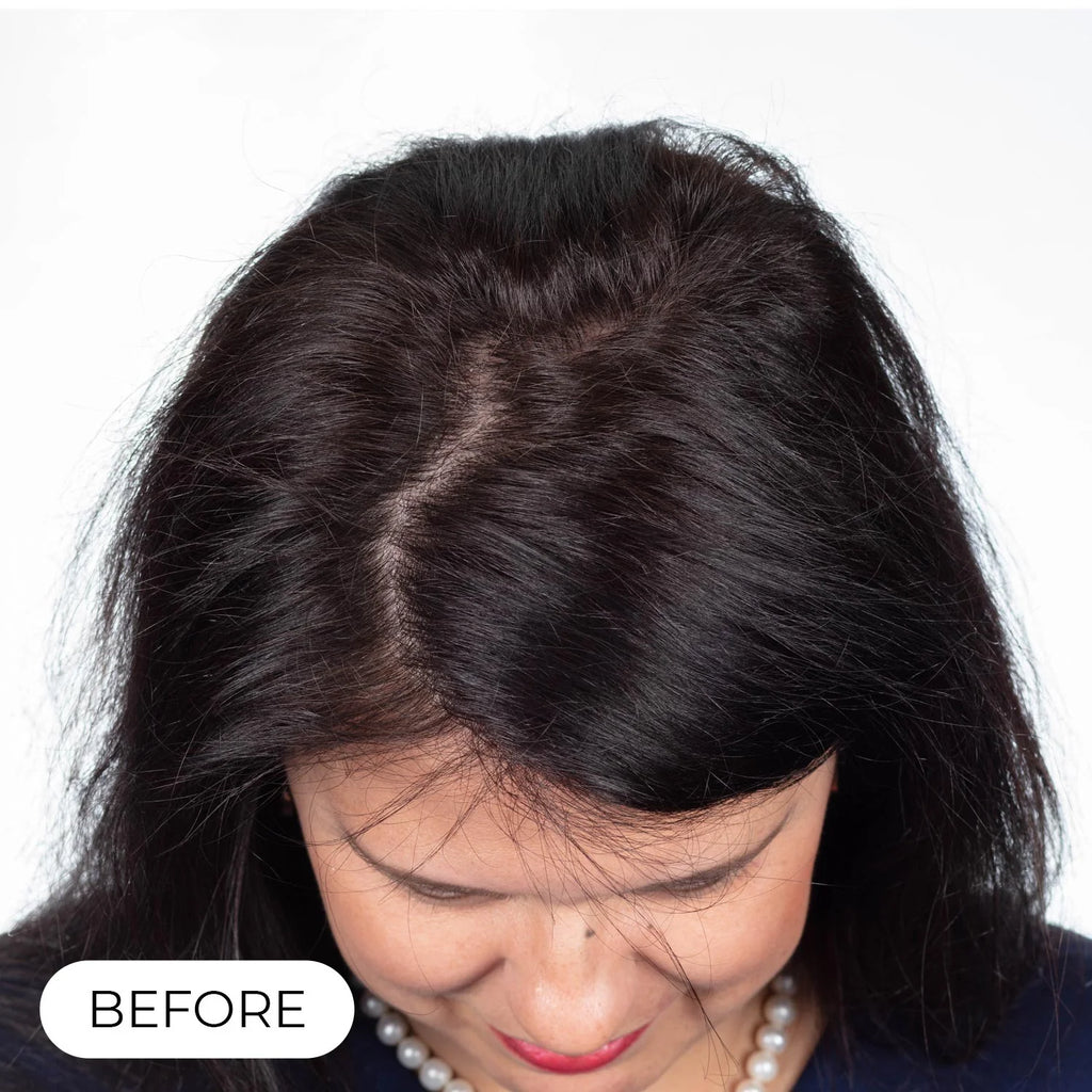 Capillus PLUS S1 casque de luminothérapie à faible niveau de laser (LLLT)