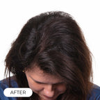 Capillus PLUS S1 casque de luminothérapie à faible niveau de laser (LLLT)