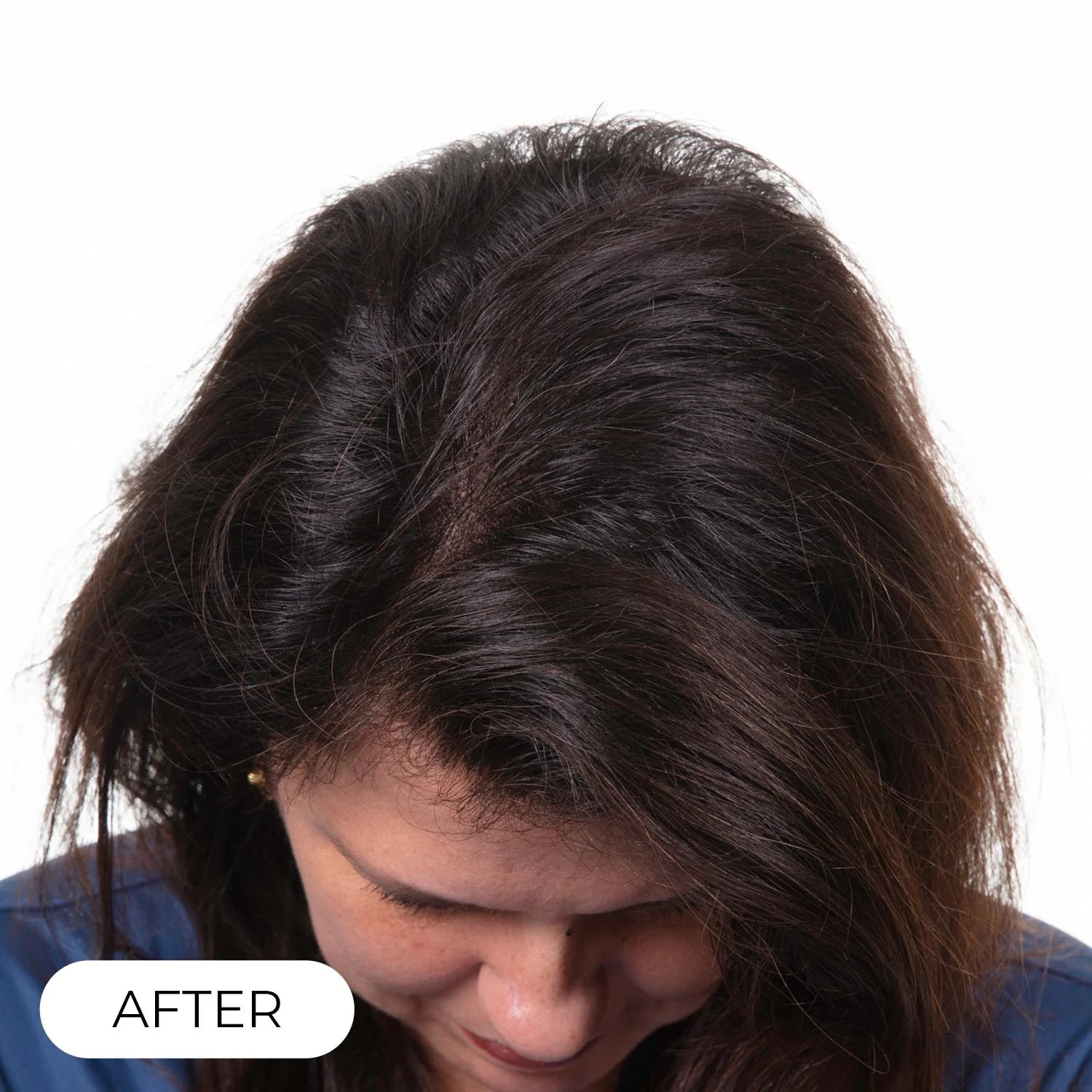 Capillus PLUS S1 casque de luminothérapie à faible niveau de laser (LLLT)