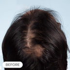 Capillus PLUS S1 casque de luminothérapie à faible niveau de laser (LLLT)