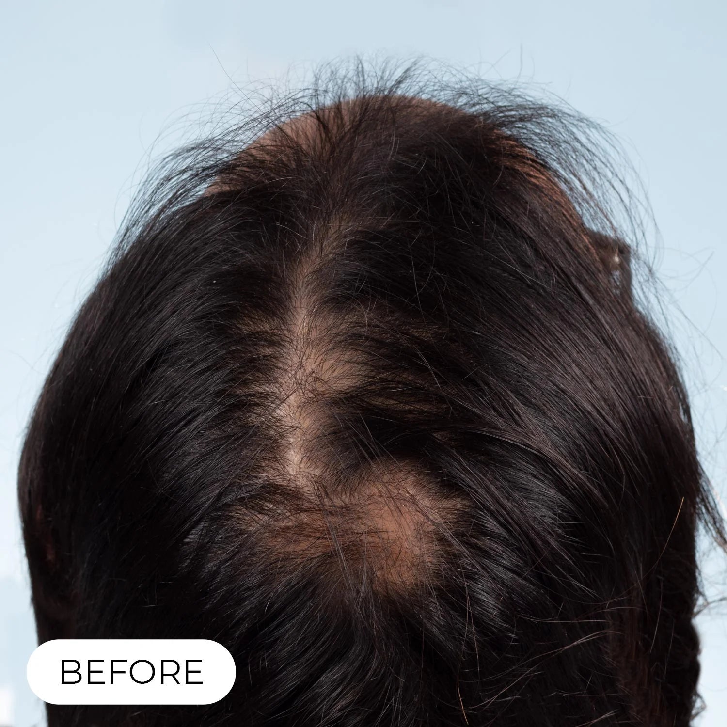 Capillus PLUS S1 casque de luminothérapie à faible niveau de laser (LLLT)