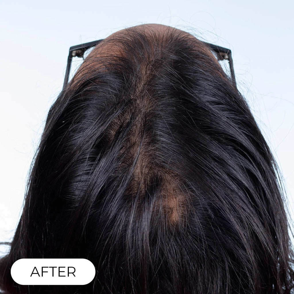 Capillus PLUS S1 casque de luminothérapie à faible niveau de laser (LLLT)