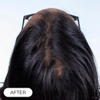 Capillus PLUS S1 casque de luminothérapie à faible niveau de laser (LLLT)