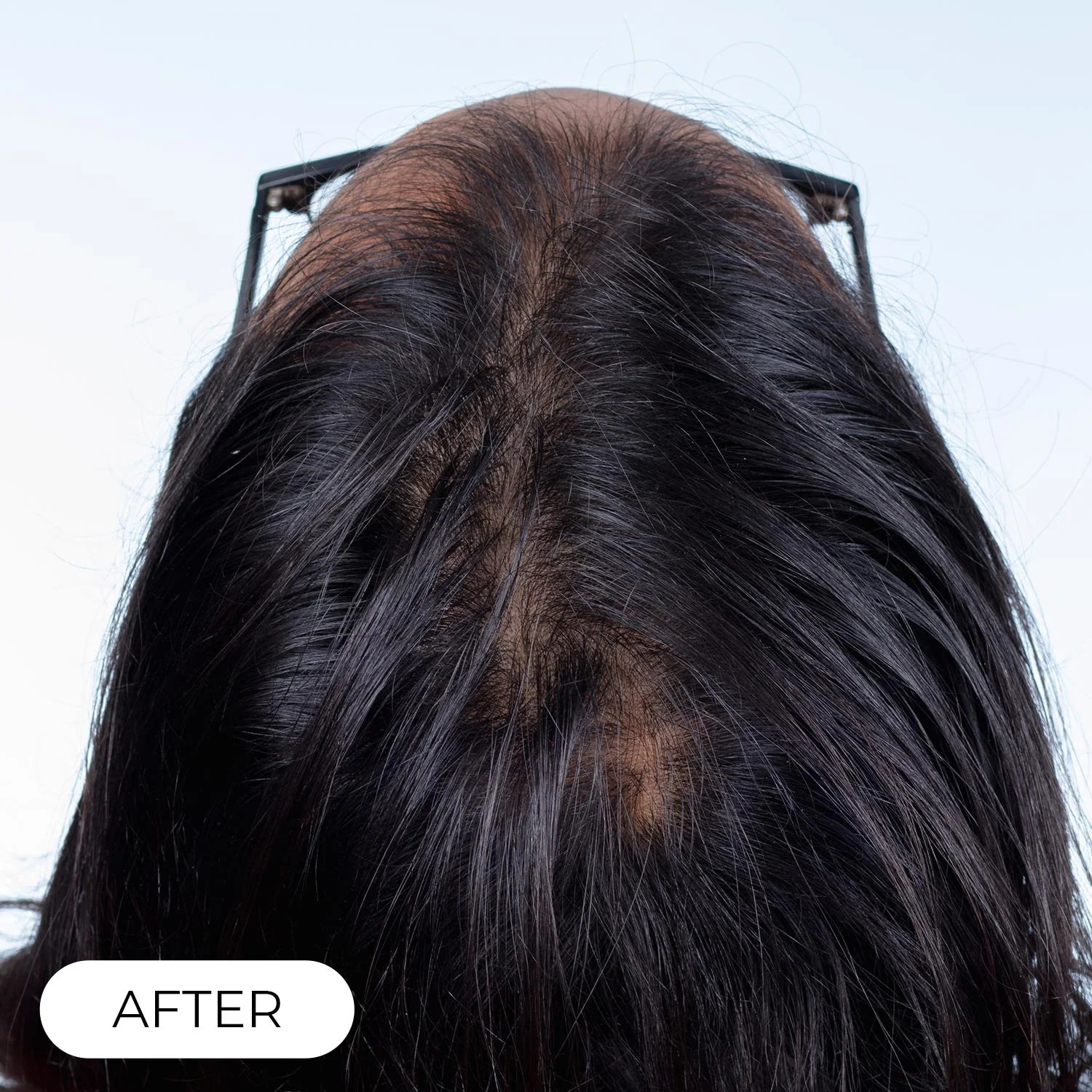 Capillus PLUS S1 casque de luminothérapie à faible niveau de laser (LLLT)