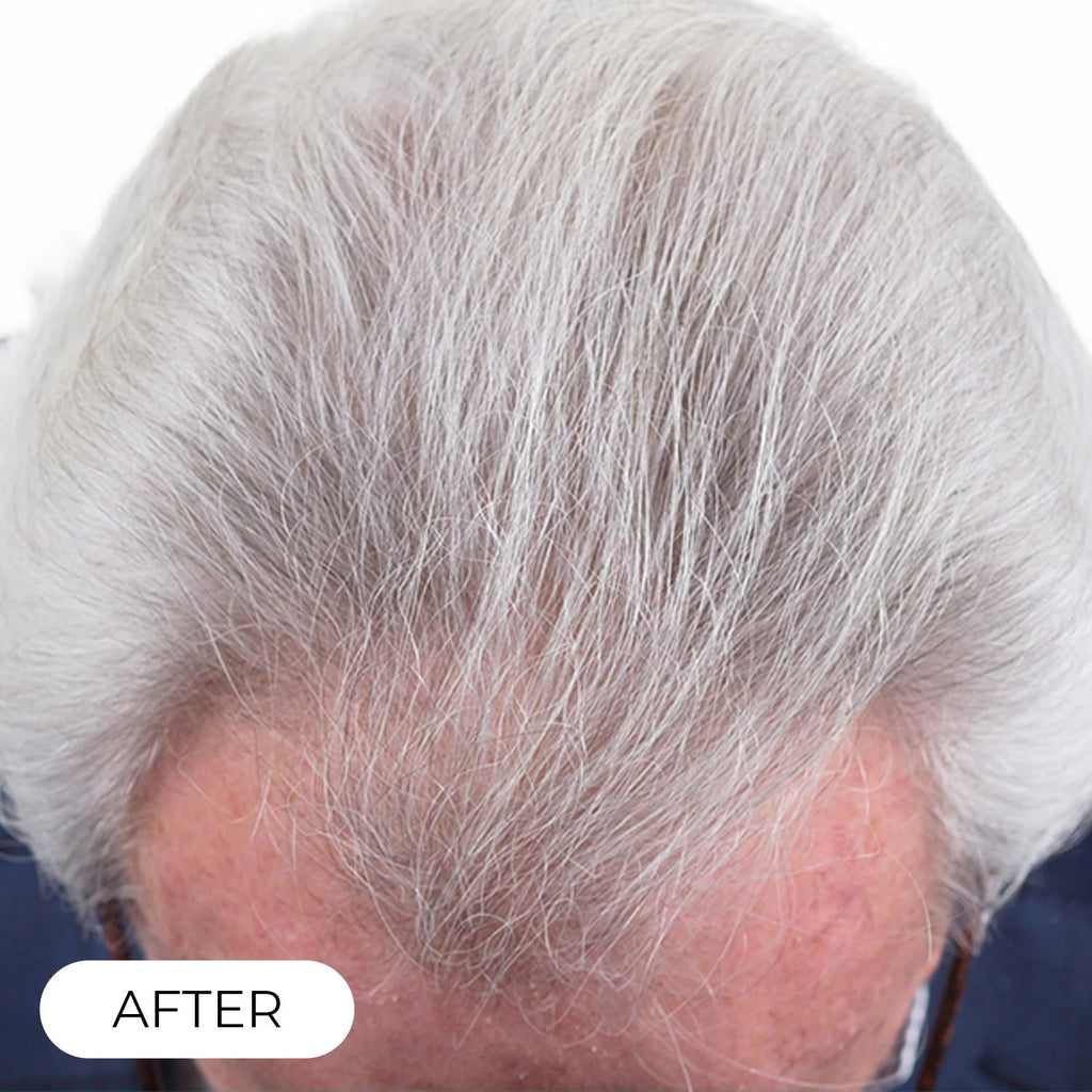 Capillus PRO casque de luminothérapie à faible niveau de laser (LLLT)