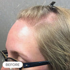 Capillus PRO casque de luminothérapie à faible niveau de laser (LLLT)