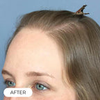 Capillus PRO casque de luminothérapie à faible niveau de laser (LLLT)